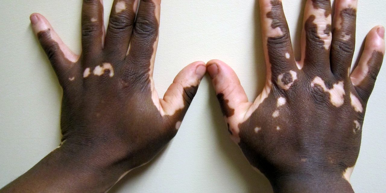 VITILIGO: THE NEED FOR AWARENESS