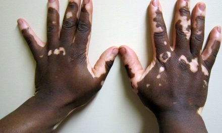 VITILIGO: THE NEED FOR AWARENESS